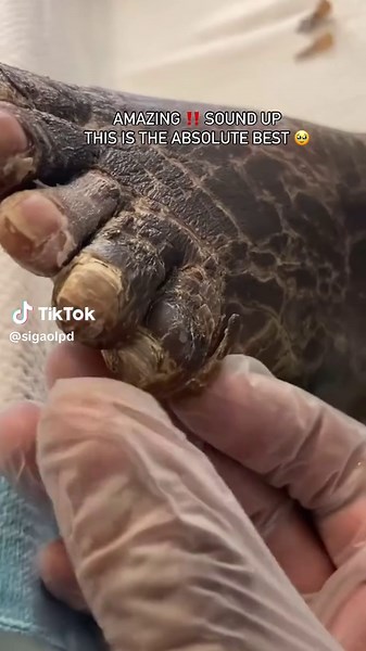 Transformação de Unha Encravada: Veja o Resultado!