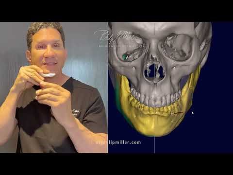 Custom 3D Jaw Implant by Dr. Philip Miller In NYC and NOLA