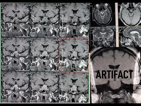 MRI Scan Pituitary gland with Dynamic scan || SFOV Artifacts? || on open MRI system