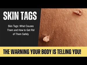 Skin Tags: What Causes Them and How to Get Rid of Them Safely