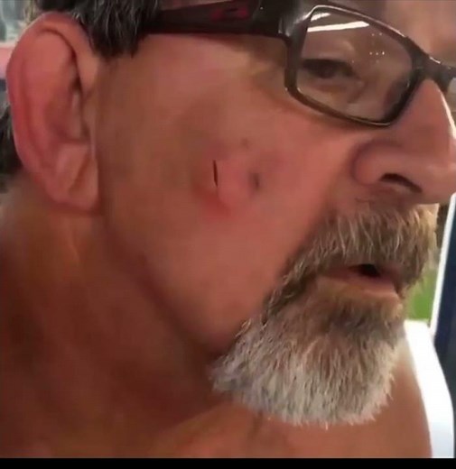 Backyard cyst pop. Cyst, cysts, cysts!