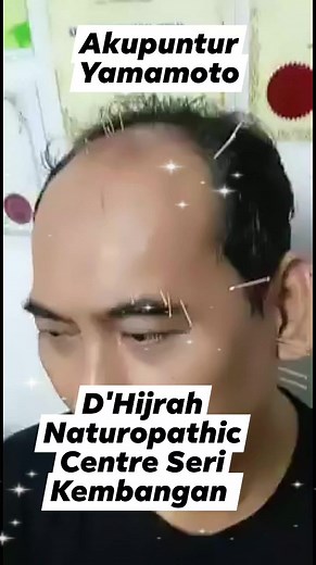 Terapi Akupuntur Yamamoto merupakan cabang Akupuntur dari Jepun. Kaedah yg tak ramai praktis. Merangsang saraf bermasalah, lancarkan aliran darah serta kurangkan sakit. Hanya di D'Hijrah Naturopathic Centre Seri Kembangan. www.dhijrah.com.my | Khairolanuar Zainuddin | Facebook