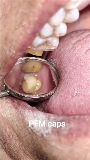 PFM caps for root canal treated teeth 🦷💫💥 #dentist #smiledesigndental #doctor #beauty #toothenamel
