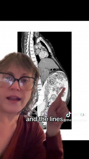 Understanding Advanced Life Support and Its Impact