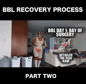 44K views · 416 reactions | My BBL recovery experience! | Domo Wilson | Facebook