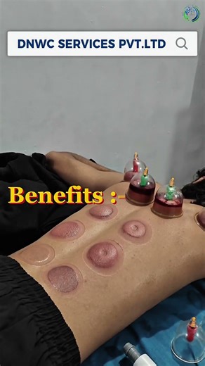 Hijama & Cupping Therapy! #reflexology #doctor #backpainrelief #backpain #holistichealth