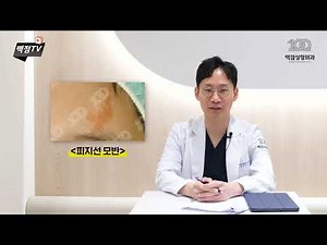 신생아 선천성모반 소아모반 어떤 종류? #멜라닌모반 #피지선모반 #화염상모반 #밀크반점
