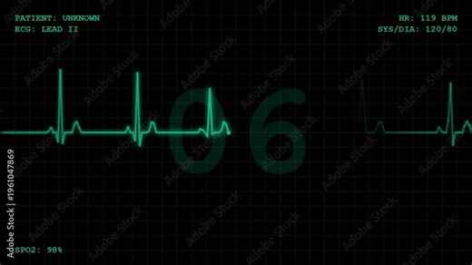 ECG Medical Heart Rate Monitor Countdown Sequence Displaying Tachycardia Leading to Flatline and Asystole Warning