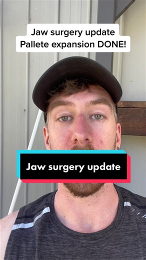 Jaw surgery update! The expander is finally OUT of my mouth and i have finally healed from surgery one, palate expansion. Ive also got nice teeth for the forst time in my life! Surgery two coming up hopefully in june, maxilomandibular advancement surgery or MMA. Next step: design my new face. Currently, sleep apnea synptoms are worse but that is to be expected at this point in the journey. Halfway done now. #jawsurgery #jawsurgeryrecovery #mmasurgery #osa #sleepapnea #cpap #palateexpander #brace