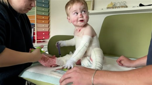 Watch: Life raising a toddler with 'butterfly skin'