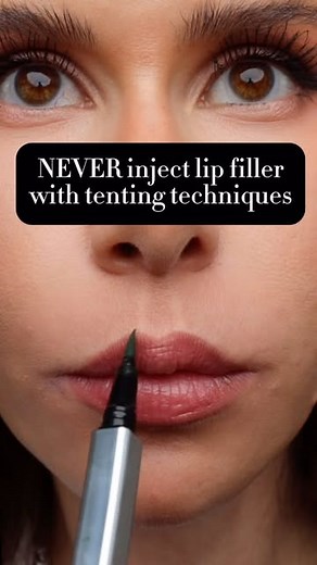 Dr Rebecka Gardell on Instagram: "Tenting technique for lip filler - yes or no?"