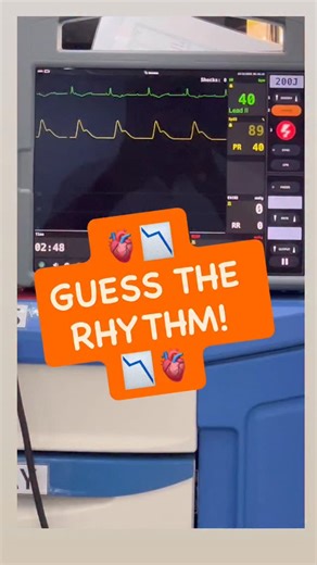 Moayad Wishah on Instagram: "🫀📉 GUESS THE RHYTHM! 📉🫀 Can you identify this ECG rhythm? 🤔🩺 ⏱️ Look closely… 👀 Analyze the waves 🧠 Trust your knowledge 💬 Drop your answer in the comments! 🚑 Emergency nurses • 🩺 Paramedics • 👨‍⚕️👩‍⚕️ Healthcare heroes — this one’s for you! ⬇️⬇️⬇️ What’s the rhythm? 🫀⚡📉🧠🚑💉📊📈🩺🔥💥 #GuessTheRhythm #ECGChallenge #ECG #CardiacRhythm #EmergencyNursing #ERLife #CriticalCare #ParamedicLife #NurseLife #MedLife #HeartRhythm #Telemetry #ACLS #HealthcareEd