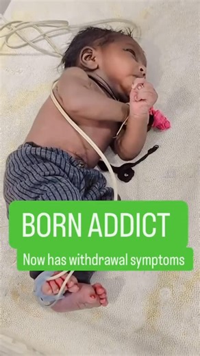 Dr. Chad on Instagram: "Neonatal Abstinence Syndrome (NAS) happens when a newborn experiences withdrawal after being exposed to certain substances in the womb—most commonly opioids. These babies can face tremors, feeding difficulties, irritability, and more. Severe cases can cause seizures. Please share to spread awareness about this horrible condition. #NeonatalAbstinenceSyndrome #NASAwareness #MaternalHealth #OpioidCrisis #NewbornCare #CompassionateMedicine #SupportMomsAndBabies #HealthcareWit