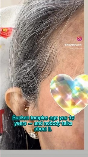 Sunken Temples Fixed With 2 Fillers — Instant Brow Lift | Dr. Ashima Goel #parisaskinclinic #threads