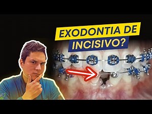 Lower Incisor Extraction in Orthodontics - When to do it?