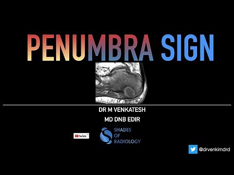 Penumbra sign - A classic sign of Intra osseous abscess