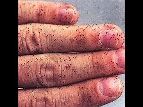 How to get rid of bird mites