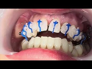 Placing on damon clear ceramic self ligating #braces