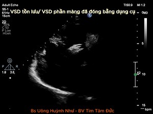 Residual membranous ventricular septal defects (VSDs) after closure with an occluder device - Thông liên thất tồn lưu sau đóng TLT phần màng bằng dụng cụ.