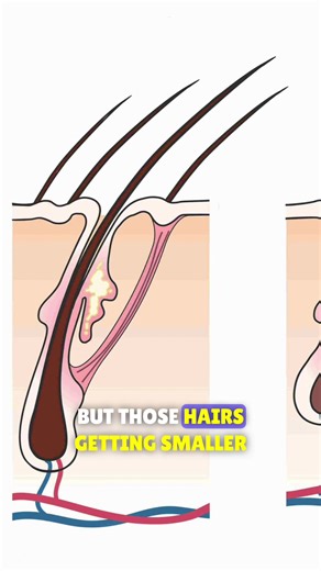 How to Identify Male Pattern Baldness