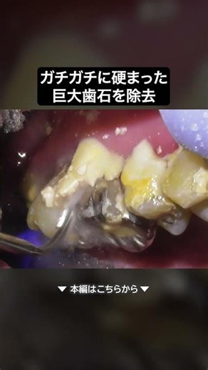 長年悩んだガチガチの巨大歯石を除去‼️
