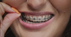 Teeth alignment by braces and elastics. Close-up female mouth. Orthodontic treatment. Correction of overbite