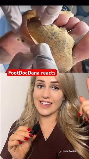 A satisfying removal (extreme trypophobia!)