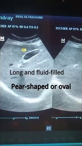 Ultrasound of Gall bladder anatomy|ScanTube #ultrasound #gallbladder