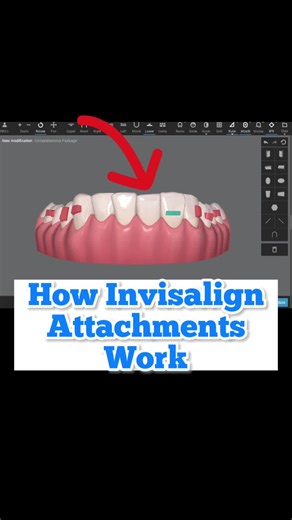 How Invisalign attachments work. An inside look at how we design smiles using Clincheck software, how we place attachments and why. #orthodontist #orthodontics #orthodontistsoftiktok #invisalign #invisaligndoctor #fortlauderdale #fortlauderdaleorthodontist #fortlauderdaleinvisalign