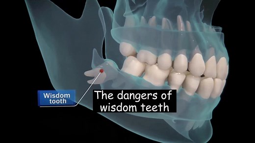 Understanding the Dangers of Wisdom Teeth: Causes and Solutions