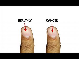 9 Fingernails serious alarming health issues and probllems