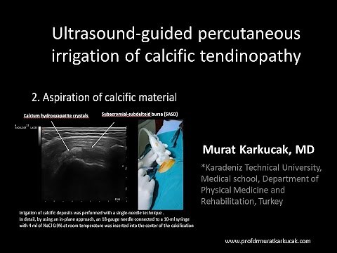 Ultrasound-guided percutaneous irrigation of calcific tendinopathy