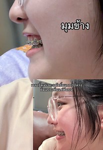 จัดฟัน ยิ้มเห็นฟันบนไหม? วิธีถ่ายรูปคนจัดฟัน