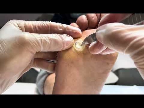 Pedicure Tutorial: A Quick Fix for Plantar Warts!