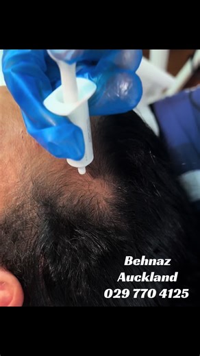 Stage 2: Intensive Follicle Activation & Strengthening Stage 2 focuses on deeper follicle stimulation and strengthening of the existing hair shafts. Using a more concentrated serum blend and enhanced needling depth, this treatment targets weakened follicles to boost cellular activity and improve nutrient delivery. This stage helps reduce excessive shedding, encourages stronger hair anchors, and supports the early regrowth initiated in Stage 1. It is designed to improve density, texture, and resi