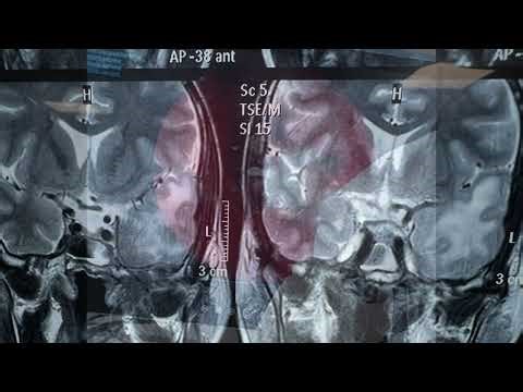 ITF INVASIVE ASPERGILLOSIS