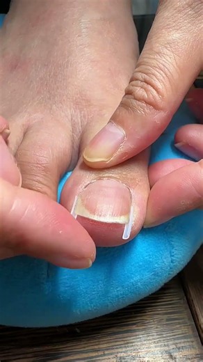 Nail Corrector #What to Do If Your Toenails Are Growing into the Flesh