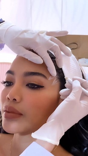 PDO Thread Lift Eyebrow lift #pdothreads #threadlift #eyebrowlift #cateyes #foxeyes #foxeye #tiktok #popular #fyp #plasticsurgery