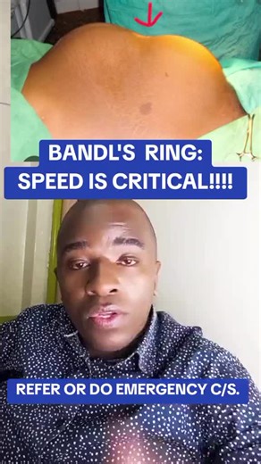 Barts Ring: The Critical Sign of Obstructed Labor