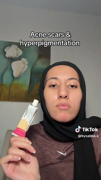 Effective Acne Scar Treatment | Hyperpigmentation Solutions