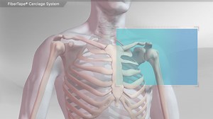 FiberTape® Cerclage System