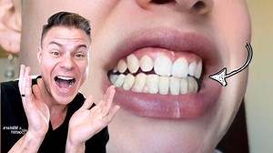 19K views · 115 reactions | Can a Retainer Straighten Crooked Teeth? 樂醴 #HealthyLiving #SelfCareSeason #retainer #teeth #dentist #smilecare | TheBentistofficial | Facebook