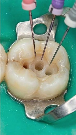 AMAZING Root Canal and tooth restoration process. See How Dentists Fix Rotten Teeth