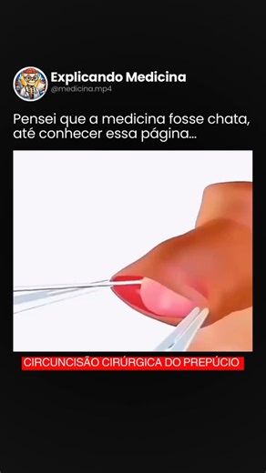 Explicando Medicina | Saúde | Curiosidades | CLIQUE EM SEGUIR 👆🏻👆🏻👆🏻👆🏻 ✂️ CIRCUNCISÃO CIRÚRGICA: O QUE É E COMO FUNCIONA A RETIRADA DO PREPÚCIO A circuncisão é um procedimento... | Instagram