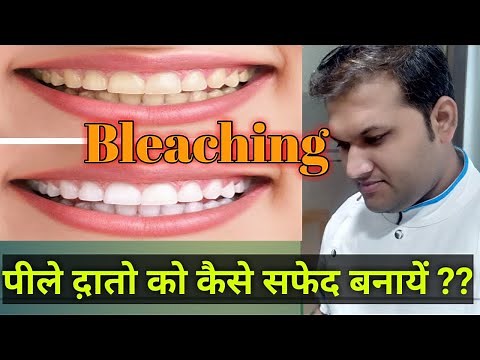 How To Whiten Your Yellow Teeth??| Dental Fluorosis Treatment | Whitening Tooth by Bleaching Paste