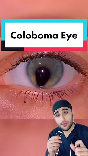 Understanding Coloboma: Causes, Symptoms, and Treatment