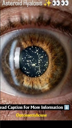 😳 White Dots Floating Inside The Eye#eyes