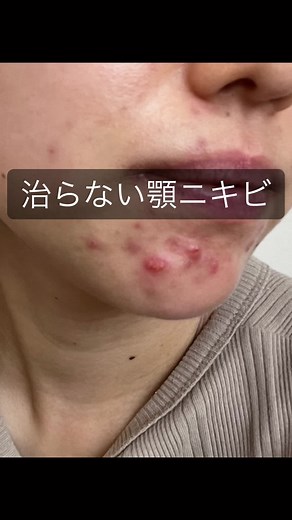 繰り返しニキビが続いてる時 治らない って思う毎日だったけど 治らない肌なんてない☺︎ 一歩踏み出して 習慣を変えよう♩ #ニキビ #顎ニキビ #ニキビ改善 #肌質改善 #ニキビ跡 #スキンケア #体質改善 #サプリメント #ファンデーション #美肌ケア #美容好きな人と繋がりたい #