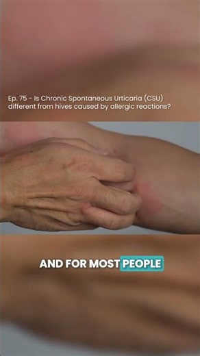 Is Chronic Spontaneous Urticaria (CSU) different from hives caused by allergic reactions?