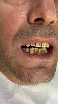 DİŞ TAŞI TEMİZLİĞİ SONRASI MÜTHİŞ DEĞİŞİM🦷🦷🦷